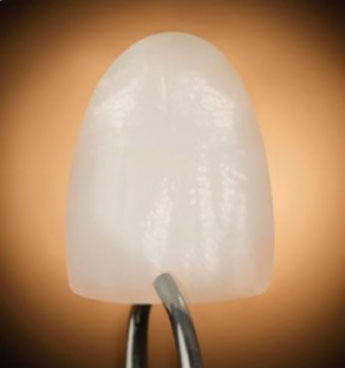 porcelain dental veneers