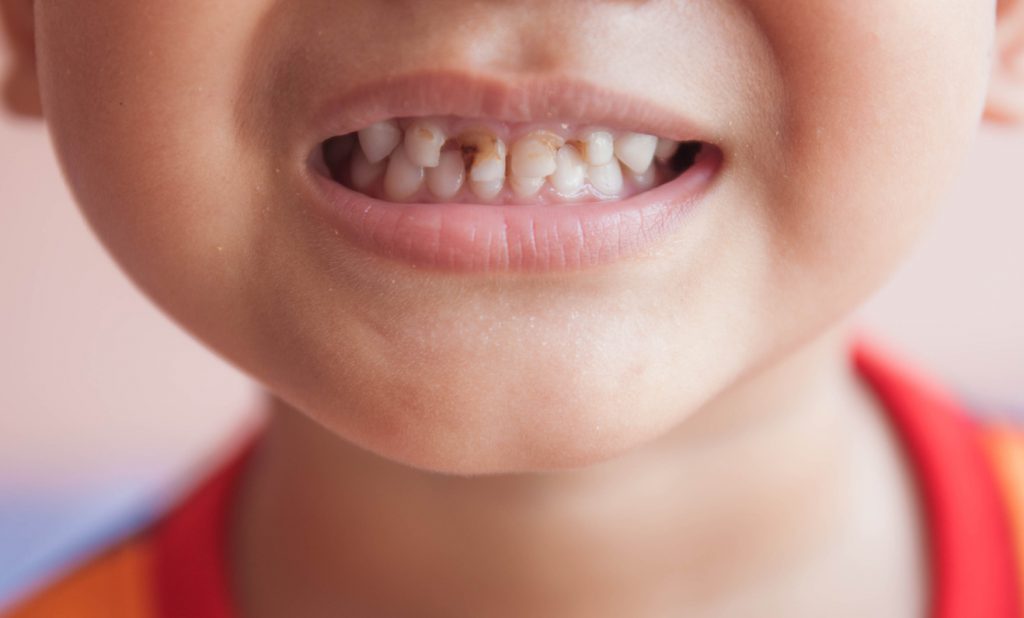 More Tooth Decay Than Broken Arms for UK Children