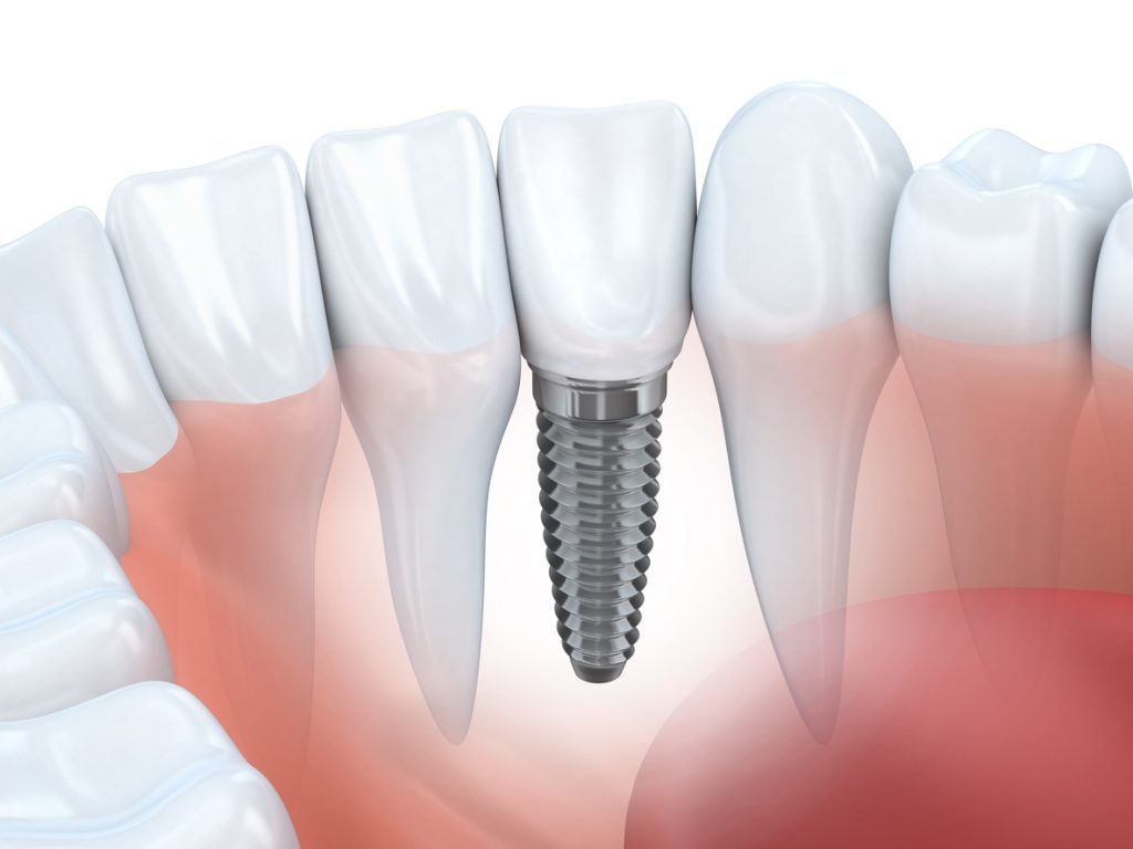 Benefits of Dental Implants