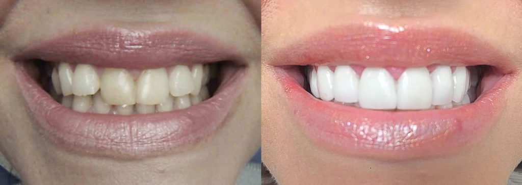 Before and after image of a smile makeover created using crowns and veneers at Leeds Dental care Liverpool