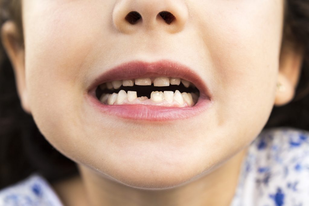 How to Prevent Tooth Decay in Children