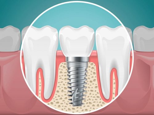 dental implant image