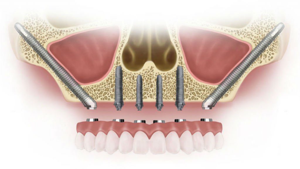 zygomatic implant placement