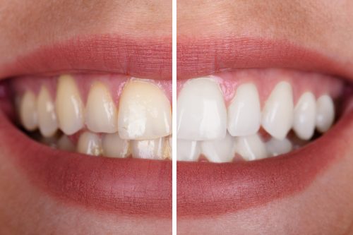 a woman's teeth before and after whitening treatment