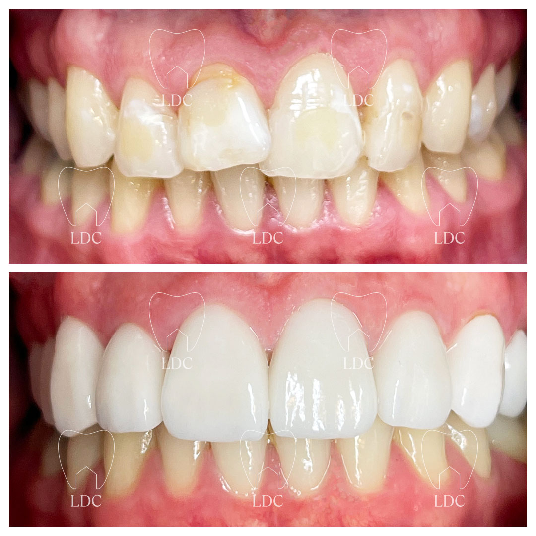Upper Emax Crowns & Lower Tooth Whitening