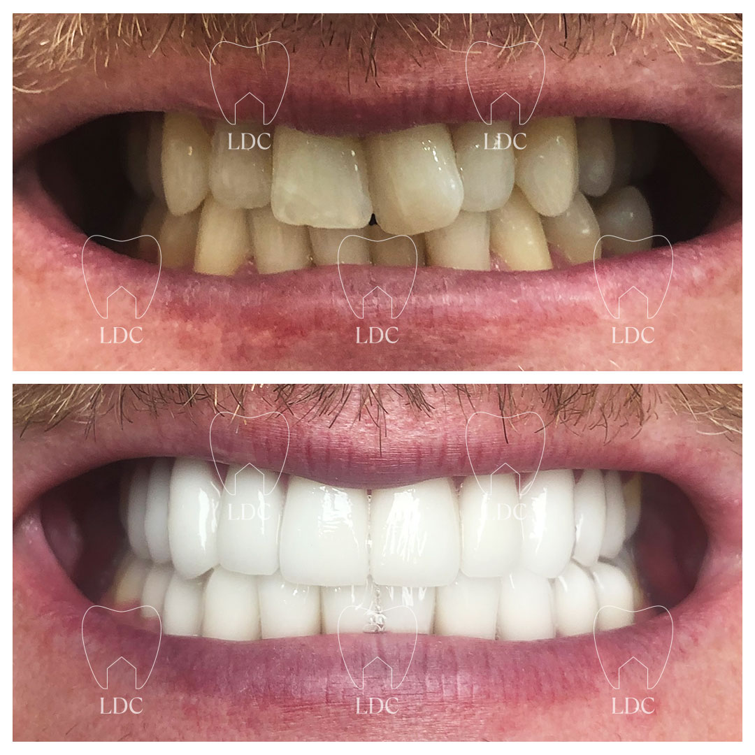 Upper & Lower Smile Makeover with Emax Crowns