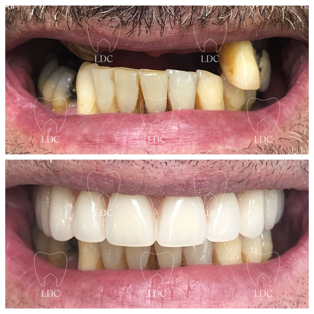 Upper Same Day Teeth with 'All on 6' Implants