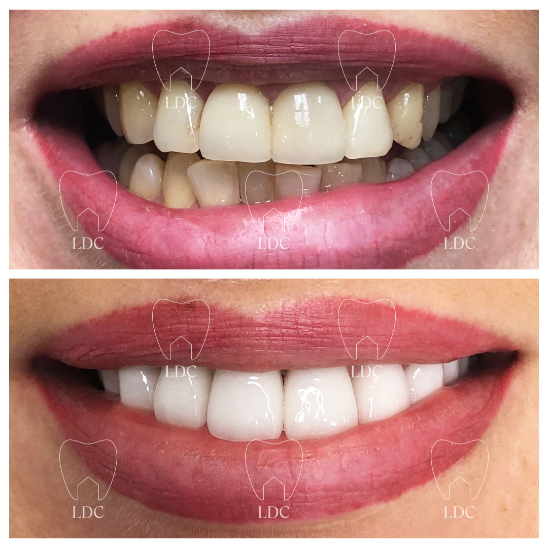 Upper Smile Makeover with Emax Crowns