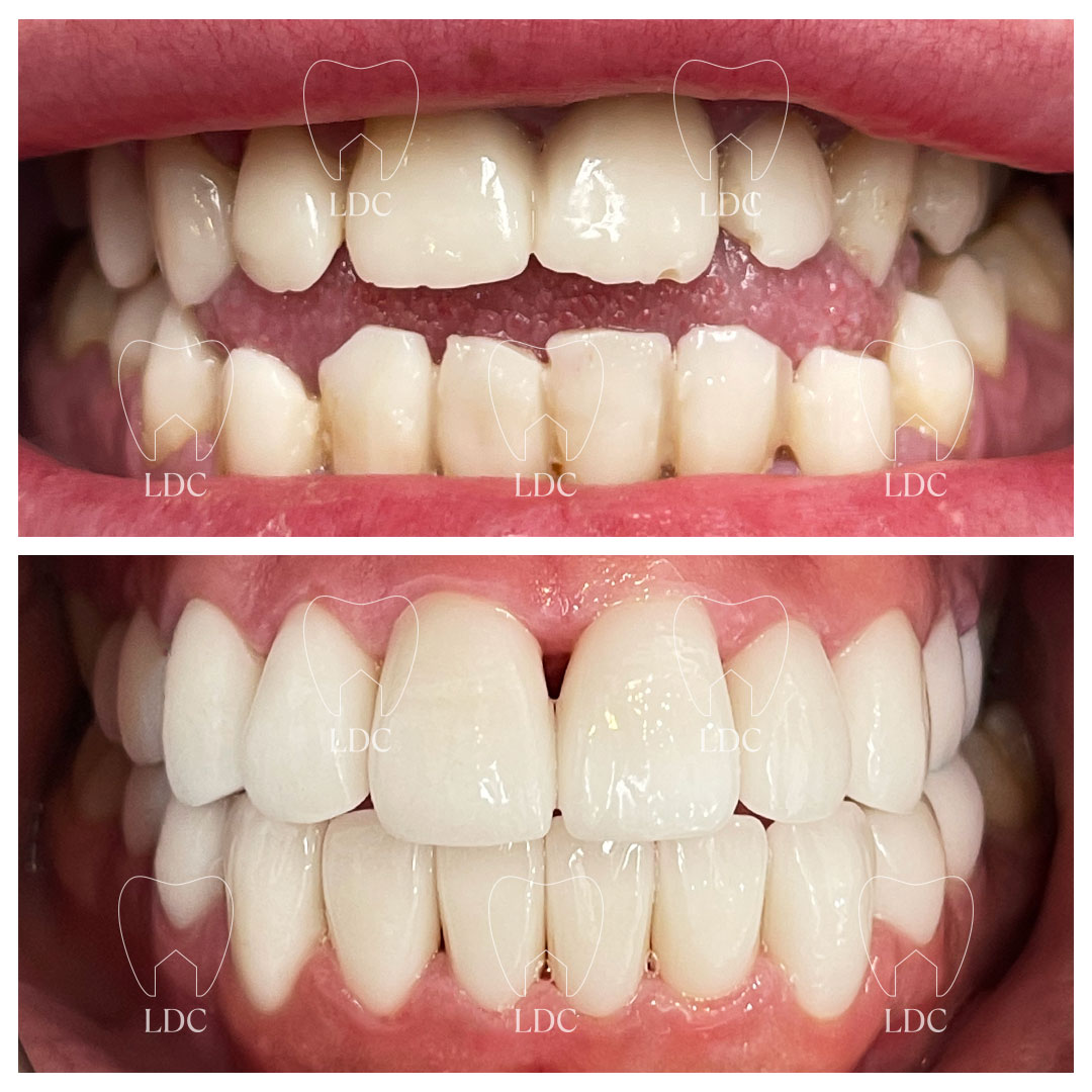 Reduction of Anterior Open Bite with Upper & Lower Smile Makeover based on Zirconia Crowns