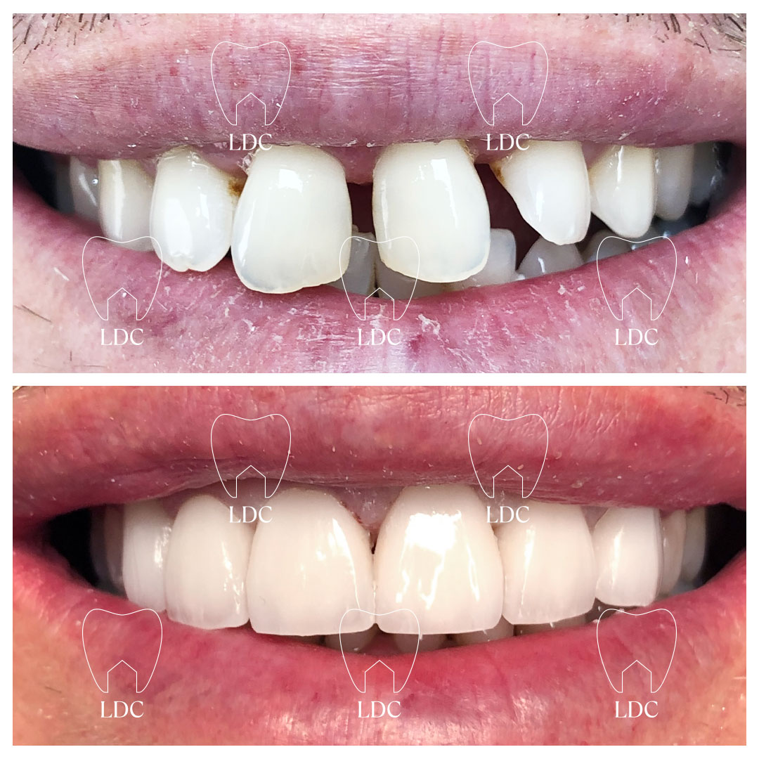 Upper Smile Makeover with Emax Crowns