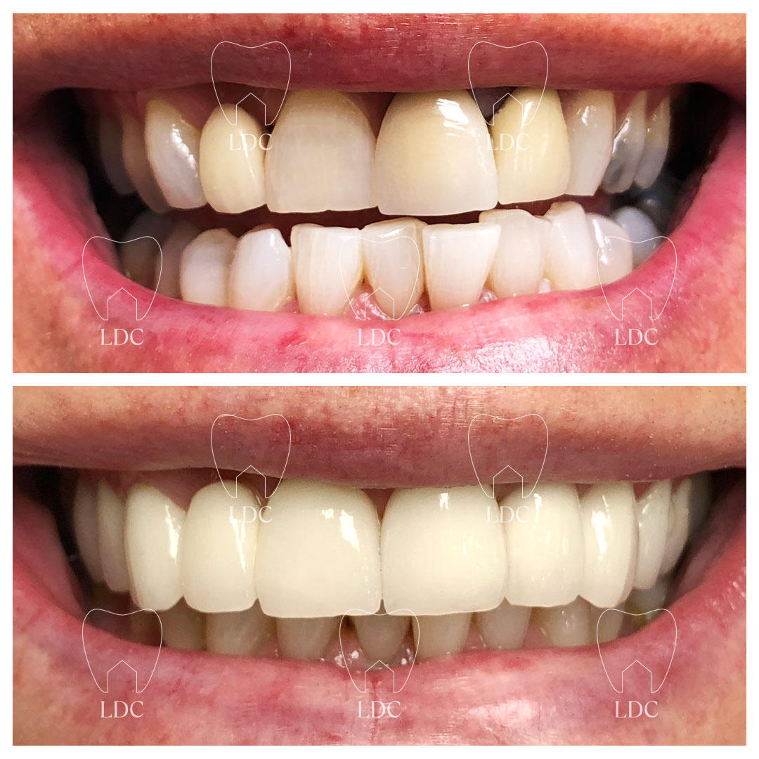 Upper Zirconia Crown Smile Makeover & Lower Tooth Whitening