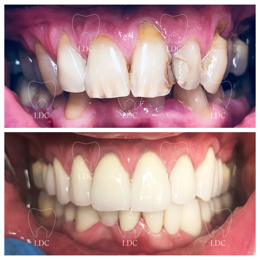 Upper & Lower Smile Makeover with Zirconia Crowns 