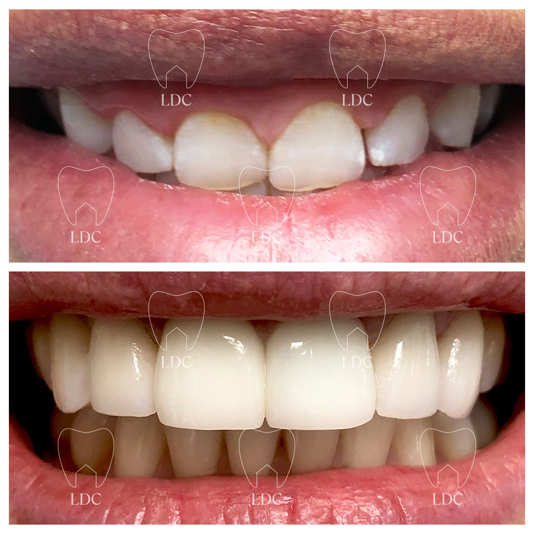 Upper Laser Gum Surgery to lengthen teeth and restored with Emax Crowns