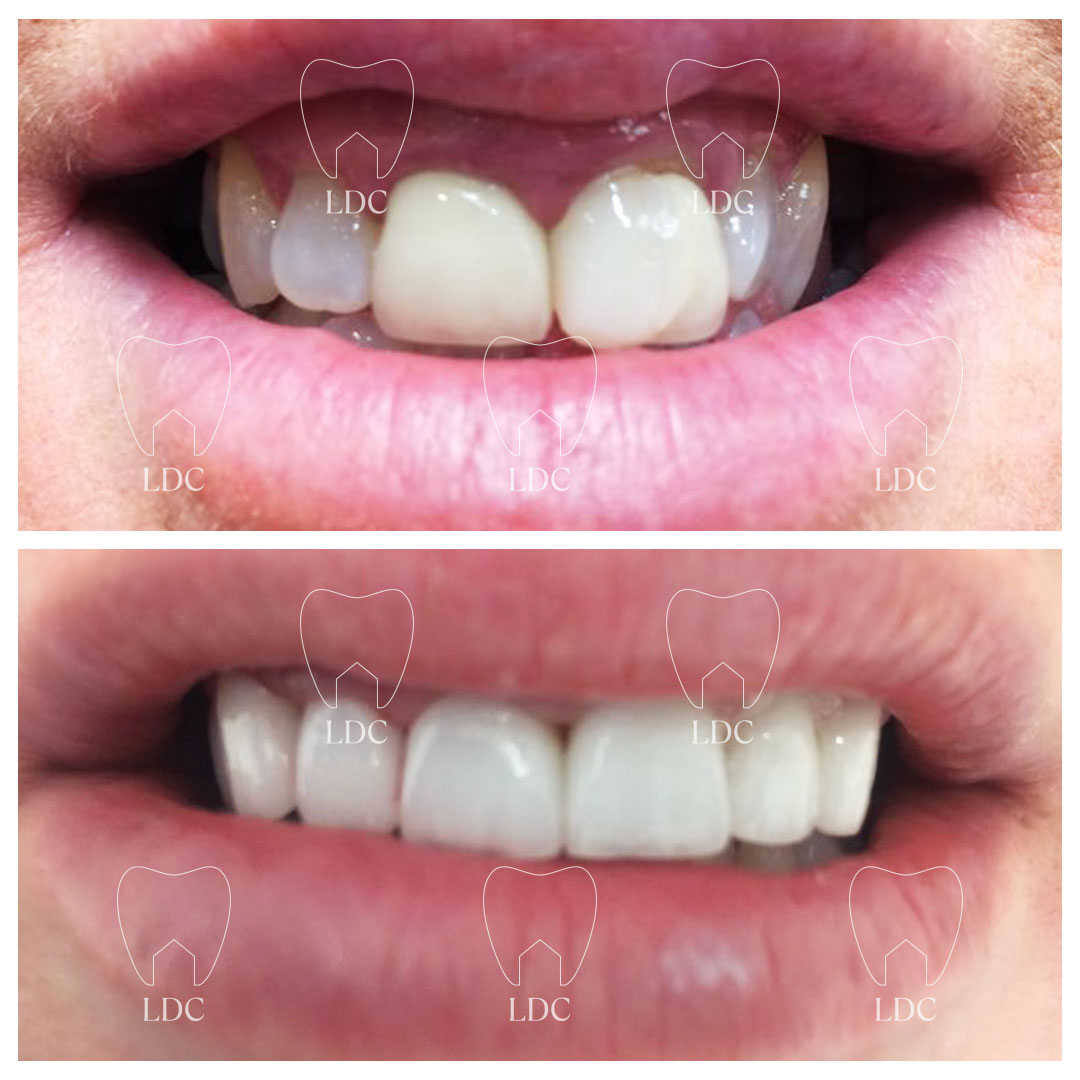 Upper Laser Gum Surgery with a Emax Crown Smile Makeover