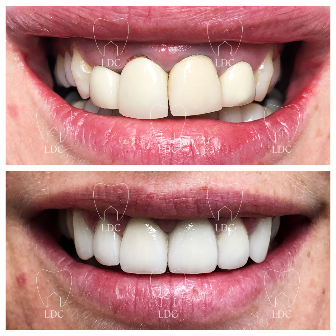 Upper Laser Gum Surgery with Emax Crowns 