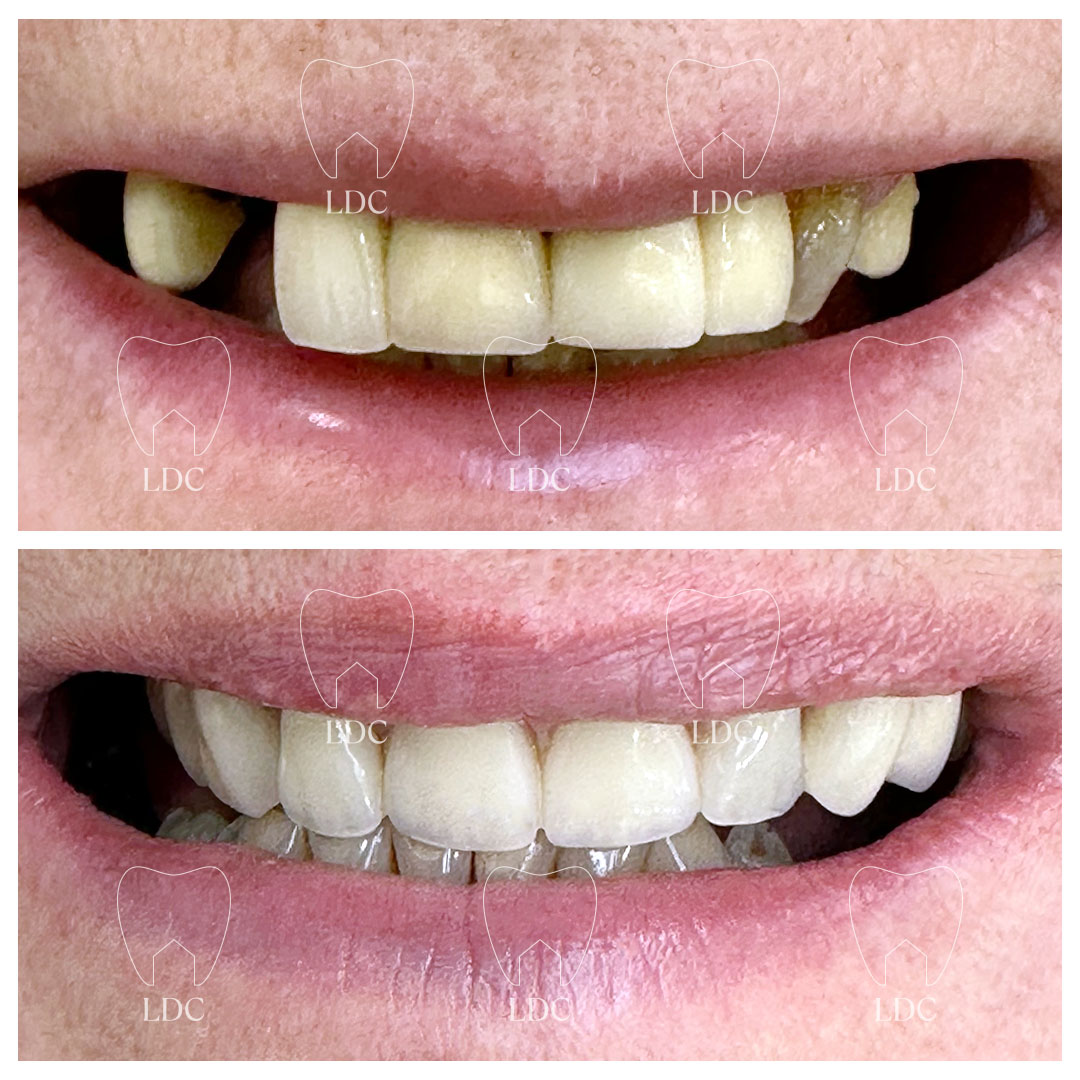 Upper Smile Makeover based on Crowns/Bridgework with Emax Crowns & Lower Tooth Whitening