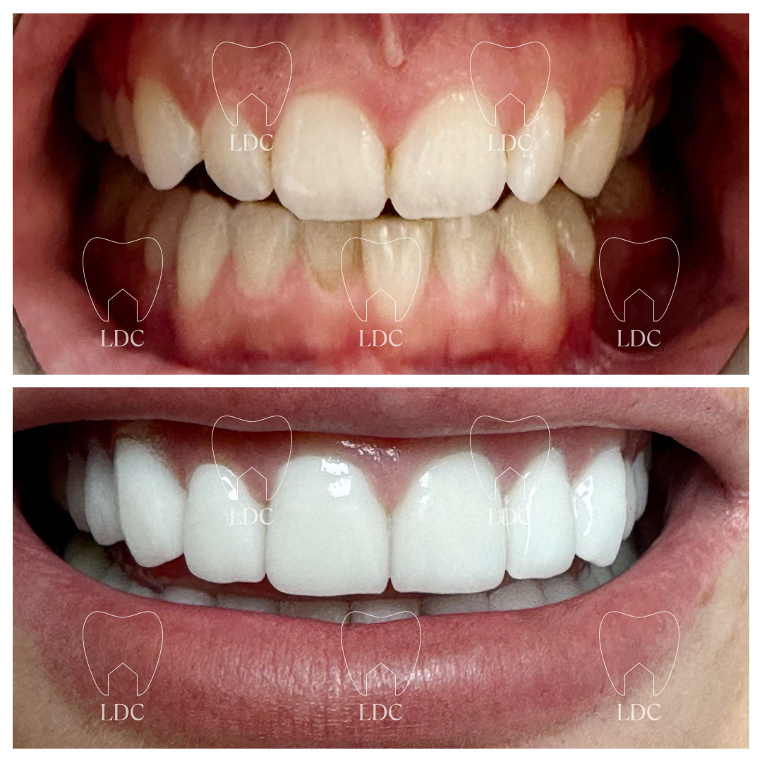 Upper Laser Gum Surgery & Emax Crown Smile Makeover with Lower Tooth Whitening