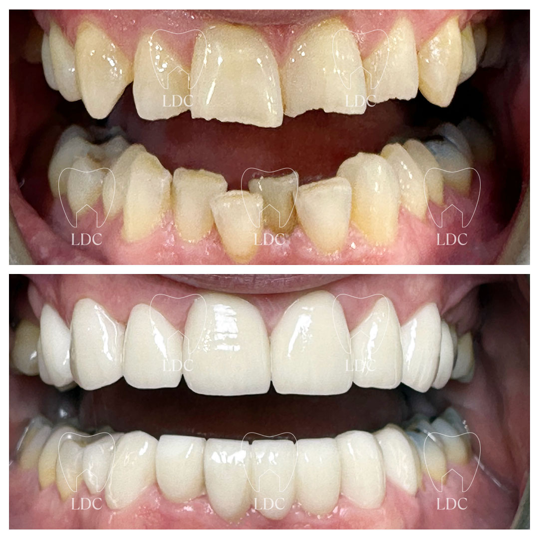 Upper & Lower Smile Makeover with Zirconia Crowns