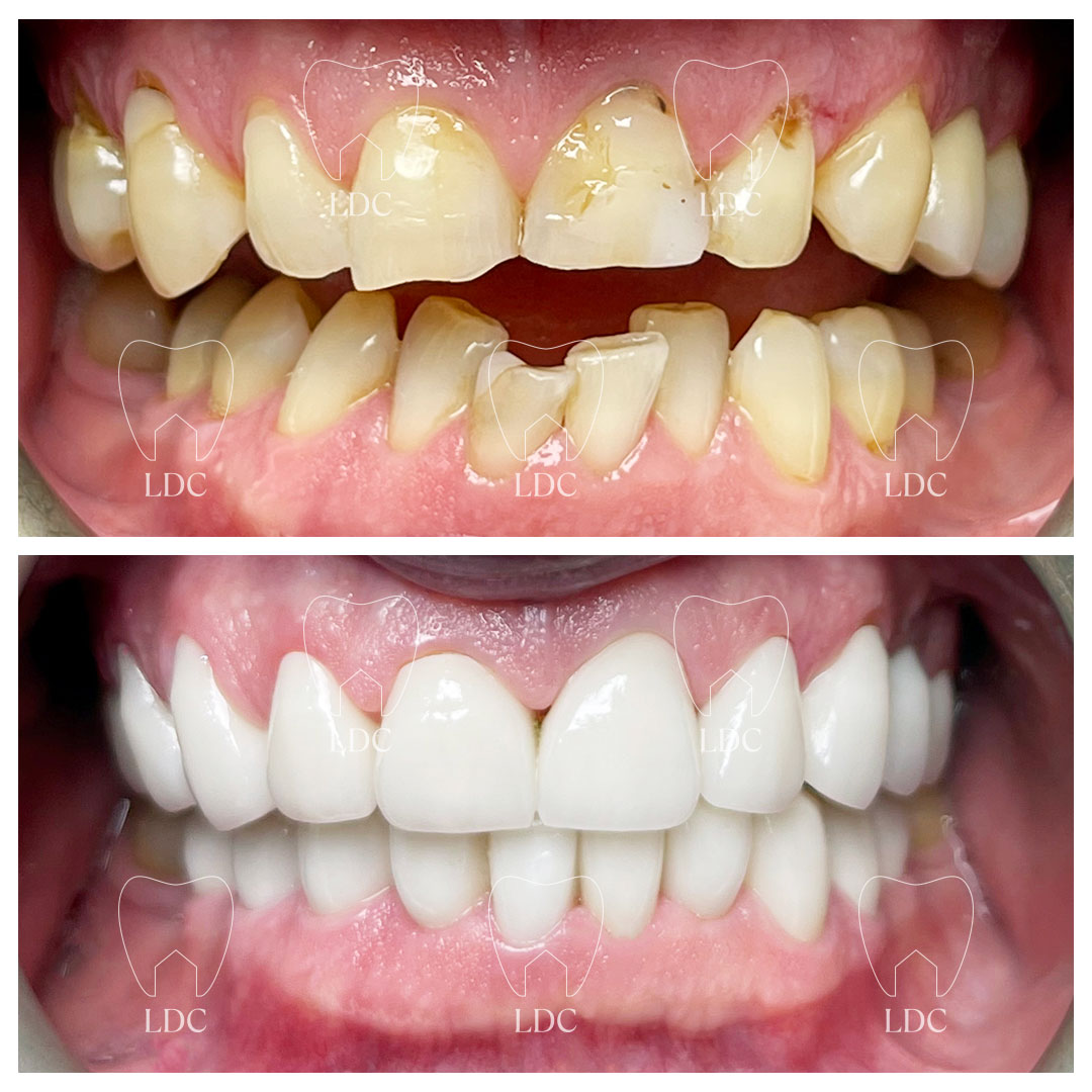 Upper & Lower Smile Makeover with Zirconia Crowns
